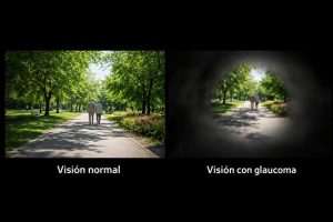 Asociación de Glaucoma para Afectados y Familiares Comparativa visiones_a